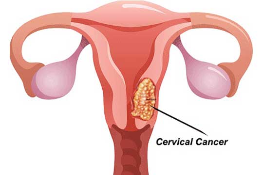 Cervical Cancer