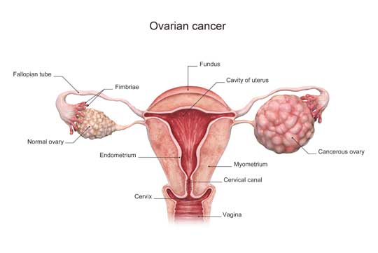 Ovarian Cancer