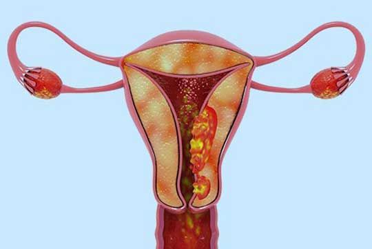 Uterine Cancer